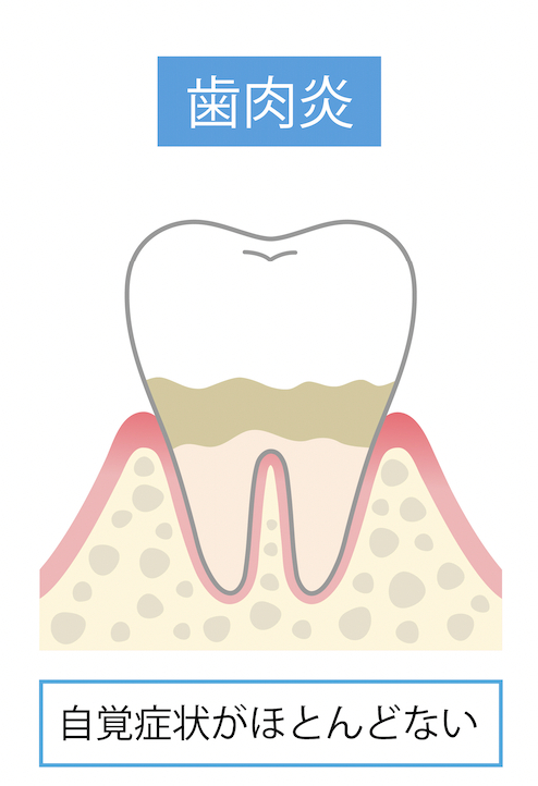 歯肉炎の場合