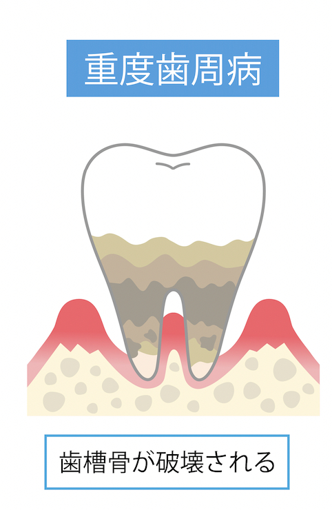 重度の歯周病